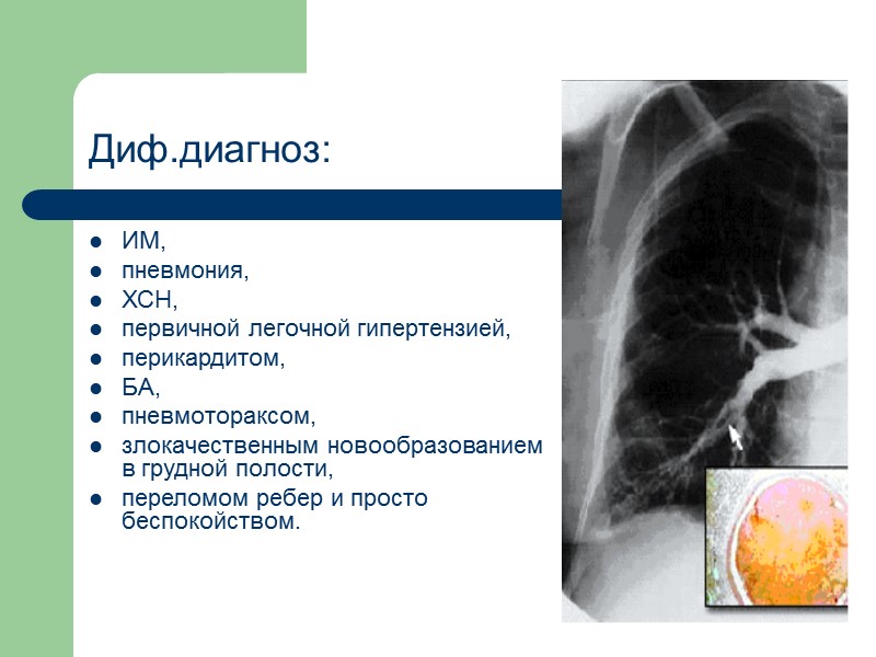 Диф.диагноз: ИМ,  пневмония,  ХСН,  первичной легочной гипертензией, перикардитом,  БА, 